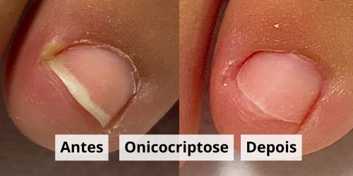 Onicocripetose